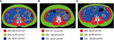 Body composition parameters combined with blood biomarkers and magnetic resonance imaging predict responses to neoadjuvant chemoradiotherapy in locally advanced rectal cancer